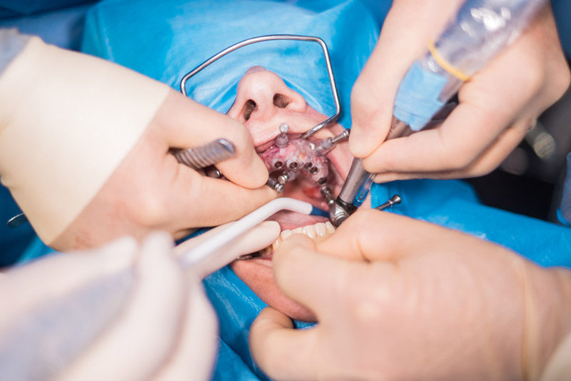 Which-Type-of-Anesthesia-Is-Used-for-This-Dental-Surgery